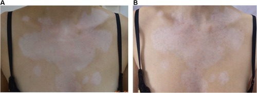 Figure 2 Patient A, areas of vitiligo on the chest (A) before and (B) 2 weeks after treatment with NCTF135.
