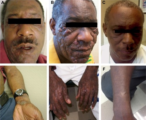 Figure 1 Disease course before and after TSEB.