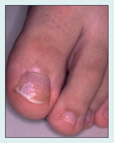 Figure 3. White superficial onychomycosis ‘classic type’ due to Trichophyton interdigitale in a 12-year-old boy: superficial white nail fragility caused by fungal colonies can be seen.