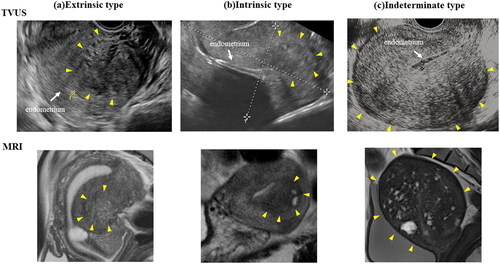 Figure 2. Representative images of the classification of adenomyosis based on the location of the lesion by TVUS and MRI. The typical ultrasound images for the extrinsic type (a), the intrinsic type (b), and the indeterminate type (c) are shown. MRI images (T2 weighted images) of the corresponding patients are also shown below them. Yellow arrows indicate the circumference of the adenomyosis lesion. The white arrow indicates the endometrium of the uterus. TVUS: transvaginal ultrasonography; MRI: magnetic resonance imaging.