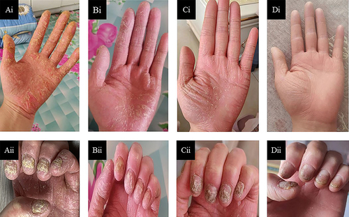 Figure 2 Presentation of severe erythematous keratotic lesions and pustules on the palms (Ai) and yellowing of nails (Aii), suggestive of palmoplantar pustulosis. Improvement of palms (Bi) and nails (Bii) after treatment with secukinumab. The palmoplantar pustules were alleviated after 3 months (Ci, Cii) and 8 months (Di, Dii) of discontinuing secukinumab and receiving treatment with tofacitinib.