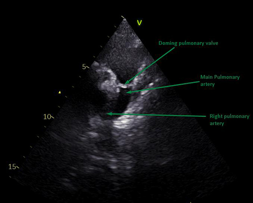 Figure 1 Echocardiography showing continuation of main pulmonary artery as right pulmonary artery and absence of left pulmonary artery.