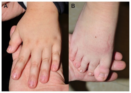 Figure 1 Photographs of (A) thumb and (B) toe.