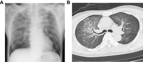 Figure 1 (A) A chest radiograph and (B) a computed tomography scan of the chest showing diffuse bilateral infiltrates.