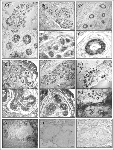 Figure 2 Photomicrographs of representative 4HNE immunostained breast tissue sections from nine subjects between the ages 17–27 y whose tissues were used for transcriptional profiling. Sections were not counterstained. Images were captured via a Nikon Eclipse E600 microscope with Nomarski optics using Spot Digital Camera (Diagnostic Instruments, Inc.) and Image Pro Plus software (version 2). Upper six panels (A–E), tissues with many strongly 4HNE+ terminal lobular ductal units (TDLU), (G–I) tissues with only few at most weakly 4HNE+ TDLUs. (A–E) Upper and lower portion of each of the panels show images captured from the same tissue section at high and low magnification, respectively. (F1) and (F2) images from sections from different tissue blocks from the same subject: In (F1) the mammary ducts are surrounded by lipocytes and in (F2) by strongly immunopositive collagenous stroma. Note: (1) in (C2), localization of 4HNE immunostaining in luminal epithelial cells in; (2) in (E2), some immunopositive nuclei in mammary epithelial cells and; (3) in (G), immunonegative TDLU is surrounded by strongly 4HNE immunopositive collagenous stroma and fat cells. Control sections incubated with medium from which the primary 4HNE antibody was omitted were uniformly immunonegative.