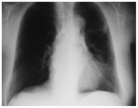 Figure 4 Chest X-ray on dismissal.