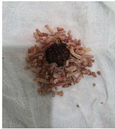 Figure 2 Prostatic chips and large bladder stone after combined TURP and vesicolithotomy.