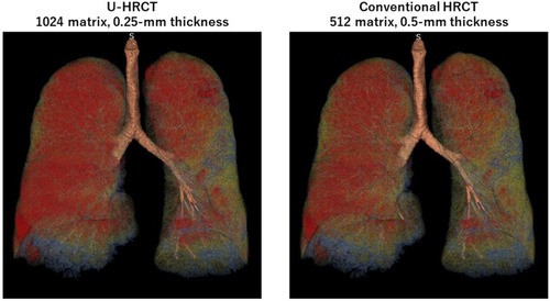 Figure 3 Quantitative measurements of lesions of pulmonary emphysema on ultra-high-resolution CT (U-HRCT) and conventional HRCT scans. Red areas are emphysematous lesions identified by the software (<−950 Hounsfield units). In this COPD patient, the percentage low attenuation volume (LAV%) was 32.8% on the U-HRCT scan (left) and 30.7% on the conventional HRCT scan (right).