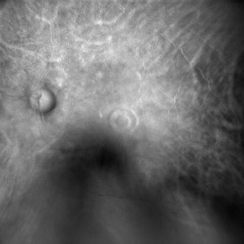 Figure 2 Retro mode pre-operative imaging of a FTMH, captured employing confocal scanning laser ophthalmoscopy, and showing alterations in RPE elevation at the hole’s boundaries.