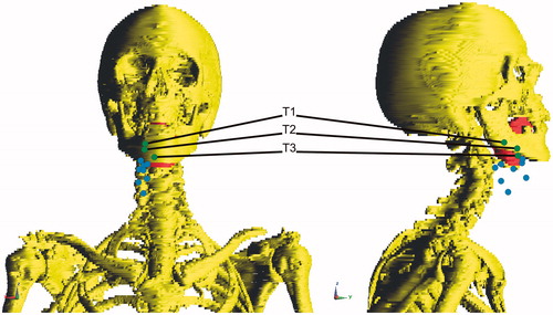 Figure 8. [Case 2] Frontal and sagittal view of the patient. For clarity, only segmented bone and CTV are shown and only the probes within the CTV are labelled. Blue probes are probes outside the CTV, green probes (T1, T2 and T3) are within the CTV and are used to partly base our steering actions on.