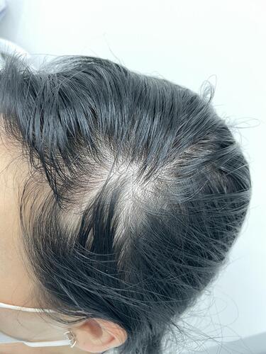 Figure 2 Acute reduction in total hair density in a 37-year-old female who is recovering from moderate SARS-CoV-2 infection. The diffuse hair loss is most noticeable in the frontotemporal region and first developed within two months after COVID-19. The patient also reported high levels of anxiety caused by the acute hair loss.