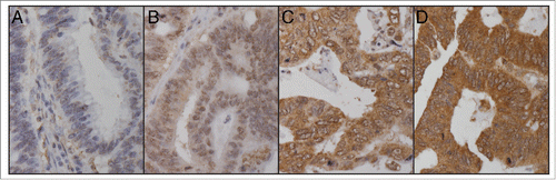 Figure 1. TKTL1 immunohistochemical staining of colorectal cancer samples. Samples were scored for cytoplasmic intensity by a 4-grade scale as follows, (A) negative (B) mild (C) intermediate (D) strong. Original magnification was 400X.
