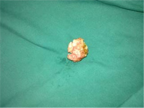 Figure 1 Surgical specimen of paraganglioma of vagina.