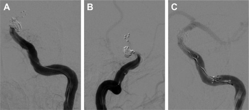 Figure 5 Head DSA images showing occlusion of the left internal carotid artery.