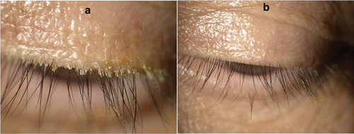 Figure 6. Representative example of the impact of treatment on collarettes. These photos show the left eye of study participant 001–312 at baseline (A) and after 42 days of treatment with lotilaner, 0.25% ophthalmic solution (B).