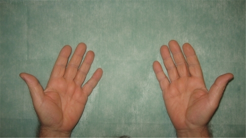 Figure 4 The palmar region of both hands was clear.