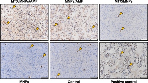 Figure 7 Enhanced induction of apoptosis by nanochemothermia.Notes: Representative images of tumor sections stained by TUNEL assay at 48 h after AMF exposure (n=3). Apoptotic areas are indicated by brown staining of the nuclei and cytoplasm. Representative apoptotic nuclei were marked by arrows. Throughout all in vivo experiments, nanoparticle concentrations of 1 µgFe/mm³Tumor were used. AMF: H =15.4 kA/m, f =435 kHz; positive control: DNAse I treated sections; scale bar: 50 µm.Abbreviations: AMF, alternating magnetic field; MNPs, magnetic nanoparticles; MTX, methotrexate; TUNEL, transferase dUTP nick end labeling.