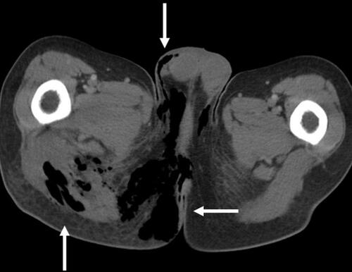 Figure 3 Sagittal Computed Tomography (CT) Image of the Perineum. Note the subcutaneous and fascial emphysema tracking from the rectum throughout the perineum and scrotum (white arrows). Case courtesy of Dr Chris O’Donnell. Fournier gangrene - spontaneous perforation of rectal cancer. Radiopedia.org; rID: 16849 . Available from: https://radiopaedia.org/cases/fournier-gangrene-spontaneous-perforation-of-rectal-cancer?lang=us.Citation99