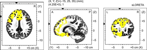 Figure 1 Voxel-wise statistical non-parametric map (SnPM) of resting state sLORETA images in all patients (n=19) compared to healthy controls (n=15) at the 0.05 significance level after the correction for multiple comparisons. Yellow/red shades indicate increased delta sources (red for P<0.1; yellow for P<0.05). Structural anatomy is shown in gray scale (A – anterior; P – posterior; L – left; R – right).
