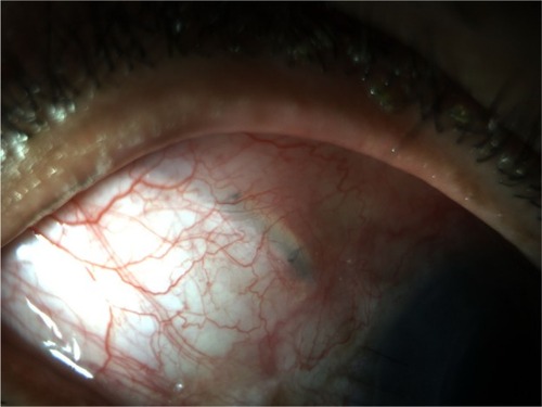 Figure 3 Postoperative view (month 1) demonstrating excellent cosmetic appearance using the gamma-irradiated cornea allograft.