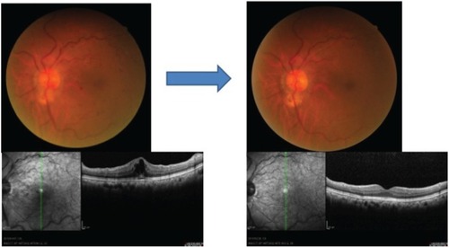 Figure 1 Case one: fundus and optical coherence tomographic images of a 72-year-old woman with a CRVO before and after treatment of systemic hypertension with a calcium blocker.