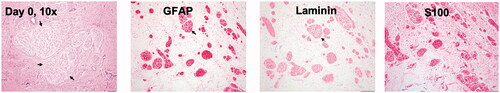 Figure 1. Schwannoma cells forming multinodular masses (arrow) supported by a loose fibrovascular stroma (H&E stain, 100× magnification). The neoplastic cells showed strong cytoplasmic immunoreactivity for GFAP, laminin, and S100 (immunostaining, 100× magnification).