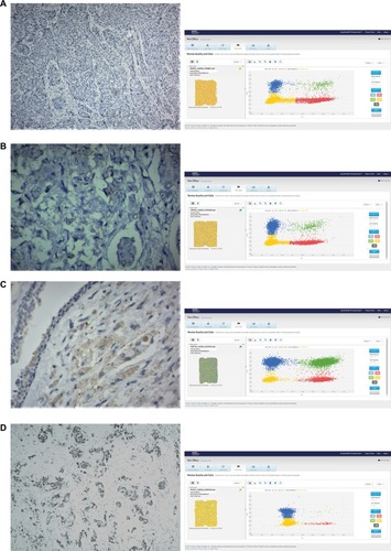 Figure 5 HER2 expression levels were evaluated by IHC and dPCR in FFPE tissue.