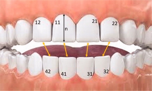 Figure 1. Distance measured to assess open bite.