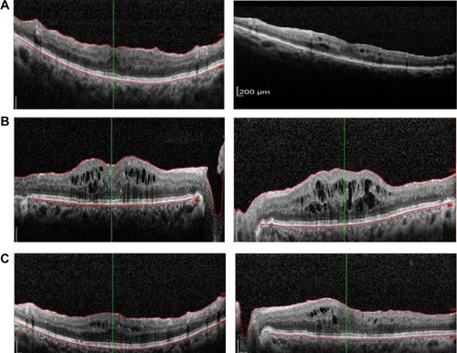 Figure 3 (A) Optical coherence tomography images of both maculae showing marked reduction in the intracellular and subretinal fluid 8 weeks after systemic treatment for diabetic nephropathy. (B) Optical coherence tomography images of both maculae showing recurrent macular edema with the discontinuation of the diuretic and angiotensin-converting enzyme inhibitor medication. (C) Optical coherence tomography images of both maculae 1 month after resuming the diuretic and angiotensin-converting enzyme inhibitor, showing improvement only in the macular edema.
