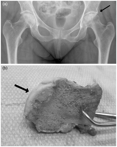 Figure 1. Radiograph of hip joints in 54-year-old female patient with acute lymphoblastic leukemia showing osteonecrosis of the left femoral head (arrow) (A). Cross-section of the femoral head during the total hip arthroplasty procedure showing osteonecrotic lesion and partial collapse of the femoral head (arrow) (B).