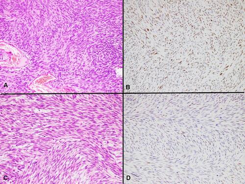 Figure 2 TLE1 IHC staining in cellular schwannoma and leiomyosarcoma. (A) Cellular schwannoma, H&E, 20x. (B) Strong nuclear TLE1 expression in tumor cells of cellular schwannoma, 20x. (C) Leiomyosarcoma, H&E, 20x. (D) Moderate nuclear TLE1 expression in tumor cells of leiomyosarcoma, 20x.
