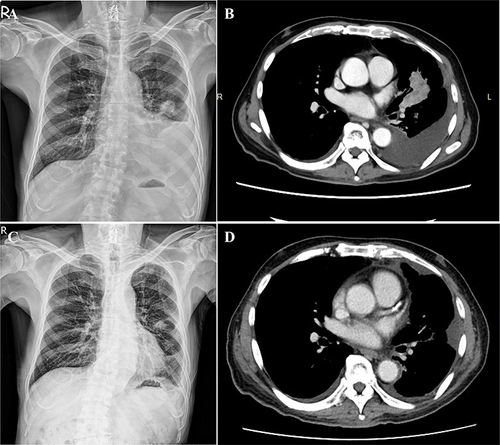 Figure 3 Radiographic findings before and after chemotherapy treatment. (A) Chest X-ray and (B) CT scan demonstrated an enlarged primary lesion in the left upper lobe with associated pleural effusion. (C) Chest X-ray and (D) CT scan revealed a decreased size of the tumor in the left upper lobe with diminished pleural effusion after chemotherapy.