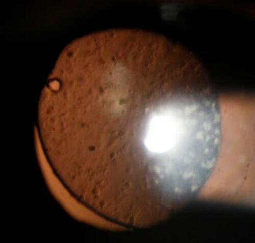 Figure 3 Lens deposits: Slit lamp capture on retro illumination shows cellular deposits on the surface of a scleral fixated intraocular lens 2wks post-surgery. Aphakia was caused by an open globe injury.