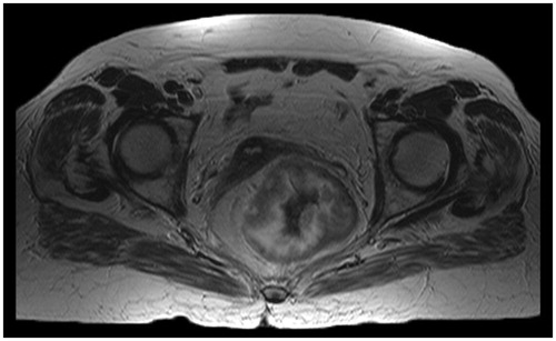 Figure 1. Magnetic resonance imaging showing the giant villous adenoma of the colon in patient 1.