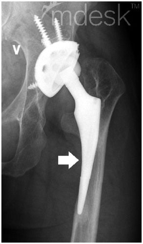 Figure 2. Example of cortical atrophy of fixed stem (white arrow).