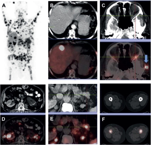 Figure 3. May 2012. A 68Ga-DOTATATE PET-CT revealed a ‘superscan’ during a progressive phase of the neoplastic disease. There were more than 100 metastatic foci in the skeleton, demonstrating high somatostatin uptake vesicles (SUVs), indicative of somatostatin receptor expression (A: maximum intensity projection image, MIP). Other metastatic sites included liver (B), retro-orbital space (C), kidney (D), pancreas (E), and the femur marrow bilaterally (F). (B–F images in the lower row represent fused PET-CT images corresponding to the CT ones shown in the upper row.)