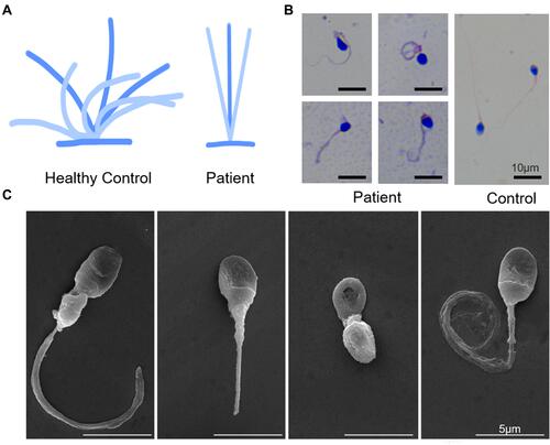 Figure 3 (A) Ciliary beating patterns of healthy cilia and our patient with CCDC40 mutations. (B) Papanicolaou staining showing morphology of the sperms from the patient demonstrated short, bent, coiled, and irregular flagella and other MMAF phenotypes. Scale bar, 10μm. (C) Scanning electron microscope of the sperms from the patient, showing bent, short, coiled and irregular flagella. Scale bar, 5μm.