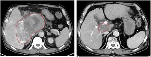 Figure 3 Change of the mass in CT after radiotherapy.