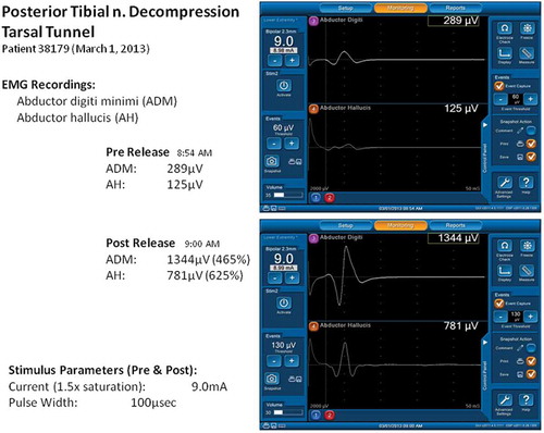 Figure 1. NIM screenshot figure of 400% improvement of motor evoked potential in the 6-minute interval for ND of posterior tibial and plantar nerves.