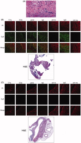 Figure 3. (A–C) Mitral valve samples show thick fibrin and fibrotic layers, lymphocytes and neutrophil granulocytes. No signs of fungi or bacteria and the findings were suggestive of non-bacterical trombotic endocarditis (A). Complement, IgG deposition and neutrophil markers (B and C). Fluorescence microscopic images of C1q, C3c, IgG, neutrophil elastase (NE) and citrullinated histone H3 (citH3) in the patient with Libman–Sacks endocarditis (B) compared with the individual with healthy mitral valve (C). Depicted are fluorescence images of tissue samples stained with PI (red), immunofluorescence images of C1q, C3c, IgG, NE and citH3 (Cy5, green) and an overlay of the respective images (Merge). The fluorescence images were taken at a magnification (20×, 300 µm × 300 µm) of the area indicated in the H&E staining (red box) of the complete sample in 4× magnification (B and C).