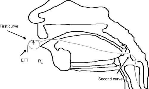 Figure 2 Diagram of endotracheal tube (ETT) curvature.Citation31