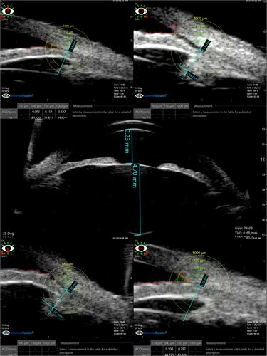 Figure 3 Collage of images of sulcus-to-sulcus axial scan and 4 quadrant scans at 12, 3, 6, and 9 clock hours of a case in the non-PI group.