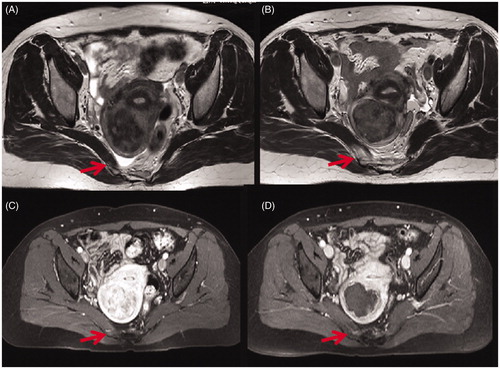 Figure 2. Transverse view of T2WI and contrast enhanced MR images obtained from a 47-year-old patient with uterine fibroids before and 1 day after HIFU. (A) Pre-HIFU T2WI image showed no abnormal signal intensity in the soft tissue adjacent to the fibroid (arrow); (B) Post-HIFU T2WI image showed a hyperintense area in the right piriformis (arrow); (C) Pre-HIFU contrast-enhanced image showed normal enhancement in the in the right piriformis (arrow); (D) Post-HIFU contrast-enhanced image showed a decreased perfusion in the area corresponds to the hyperintense area in the right piriformis on post-HIFU T2WI compared with pre-HIFU contrast-enhanced image (arrow).