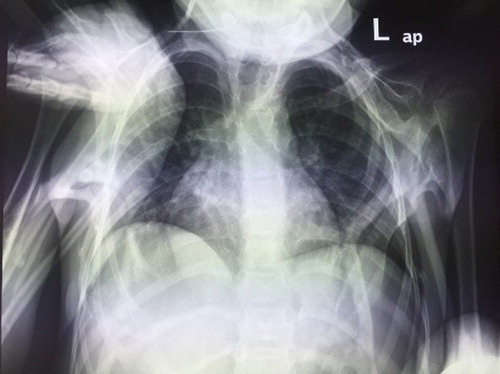 Figure 2: Chest radiograph showing heterotopic ossification of soft tissues and joints.