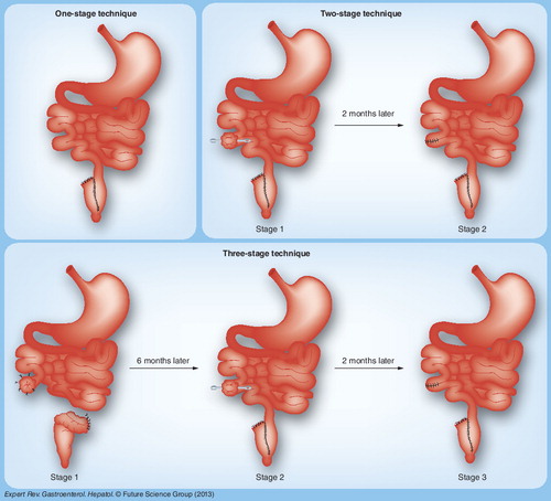 Figure 1. Staged pouch reconstruction.Three techniques are commonly used for colectomy and the creation of ileal pouch–anal anastomosis. The one-stage technique, where colectomy and pouch reconstruction are performed during the same operation (avoiding ileostomy), is performed in the healthy patient not on immunosuppressants. In the most commonly performed two-stage procedure, colectomy and pouch reconstruction with a defunctioning ileostomy is performed, followed by a reversal of ileostomy approximately 2 months later. This operation is most appropriate in the relatively healthy outpatient with minimal–moderate immunosuppressant use and a relatively good nutritional status. The three-stage technique involves colectomy and end ileostomy performed during the first operation, with proctectomy and pouch construction along with the creation of a diverting ileostomy performed during a second operation. The ileostomy is reversed during a third operation. This three-stage approach is taken most frequently in the acute/emergency setting and/or in the malnourished patient on large doses of immunosuppressants. A fourth sequence of the procedure (not illustrated), the modified two-stage procedure, comprises colectomy with ileostomy performed in a first operation, followed by pouch reconstruction without a diversion ileostomy in a second procedure approximately 6 months later, after the patient has been weaned from immunosuppressants, has an improved nutritional status and is relatively healthy.