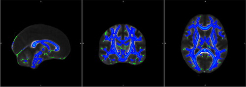 Figure 2. WM changes from baseline to the 8-month AaP treatment time point. Green pseudocolor represents normal WM and blue pseudocolor represents sites of WM impairment.