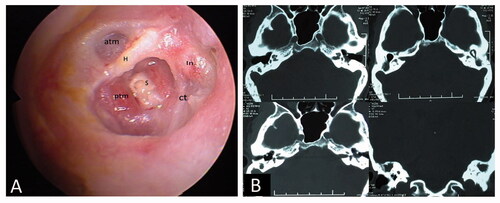 Figure 1. A. Preoperative endoscopic evaluation. B. HRCT scan of Temporal Bone- axial and coronal view. Abbreviations: H: Handle of malleus; ptm: posterior tympanic membrane retracted; atm: anterior tympanic membrane healed; s: necrosed stapes; ct: chorda tympani; In: incus with the necrosed long and lenticular process.