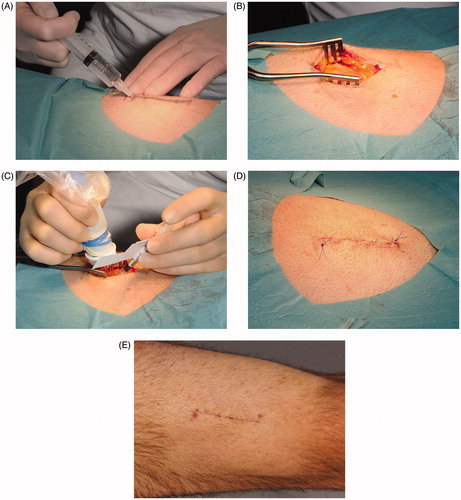 Figure 2. Treatment procedure. (A) A 6-cm long incision was marked on the thigh ∼10 cm above the patella. Local anesthesia (lidocaine 20 mg/ml with epinephrine 5 μg/ml) was injected subcutaneously. (B) Skin and subcutaneous tissue were incised to m. rectus femoris. Local anesthesia was then injected beneath the intact muscle fascia in the periphery of the exposed area. (C) A needle electrode array was placed directly on the exposed muscle fascia parallel to muscle fiber orientation. Plasmid AMEP was injected intramuscularly between the two rows in the needle array. Immediately after injection of plasmid AMEP the electrode was inserted into the muscle and a combination of one short high voltage pulse followed by one long low voltage pulse was applied. Electric pulses were delivered in less than a second. (D) After injection of plasmid DNA and delivery of the electric pulses, the subcutaneous tissue was closed with absorbable sutures and the skin closed with non-absorbable continuous suture. A compression bandage was applied for 24 h. The non-absorbable skin suture was removed 14 days after treatment. (E) Scar on the thigh 14 days after treatment.