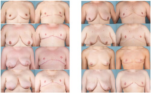 Figure 2. Pre- and post-op photos of the eight trans male patients that underwent gender-affirming top surgery. Ages ranged from 21 to 36 years old.