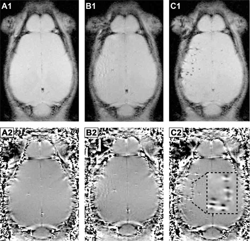 Figure S3 MRI detection at 7 T of MSC in mouse brain after carotid injection of MCP-labeled cells.Notes: Magnitude (A1–C1) and phase images (A2–C2) of mouse brain before injection (A), after injection of nonlabeled cells (B), and after injection of 1,000 MCP-labeled MSC (C). MSC trapped in blood vessels of the left hemisphere are visible as signal reductions in the magnitude image (C) and as dipole figures in the phase image (MFMD) (C2). (FLASH gradient-echo sequence, 80 µm in-plane resolution, slice thickness 300 µm, TE 5.4 milliseconds, TR 400 milliseconds).Abbreviations: MRI, magnetic resonance imaging; MCP, multicore superparamagnetic nanoparticles; MSC, mesenchymal stem cells; MFMD, magnetic field microdistortion; TE, echo time; TR, repetition time.